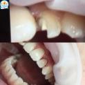 Рубрика “Клинический случай”: Эстетическая реставрация 2.2 зуба 