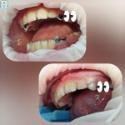 Рубрика “Клинический случай”: Жалобы на темные пятна на 5,3, 6.3, 7.3 зубах