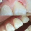 "Рубрика клинический случай": Белые пятна и дефекты эмали на 2.1 зубе