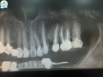 Рубрика “Клинический случай”: Киста зуба: лечить или удалять?