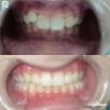 "Рубрика клинический случай": Неправильное прорезывание 1.2 зуба