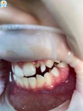 Рубрика “Клинический случай”: Разрушенность 2.2 зуба
