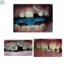 Рубрика “Клинический случай”: Неправильное положение 2.1 зуба