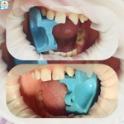 Рубрика “Клинический случай”: Скол переднего зуба